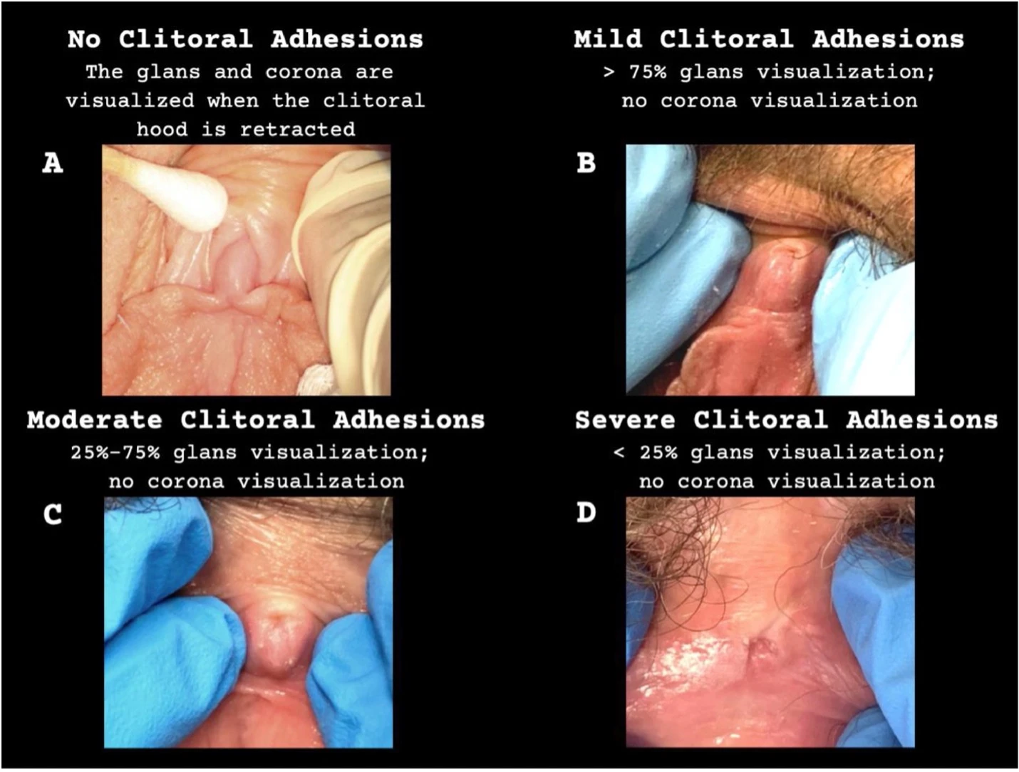Clitoral Adhesions Release Bodywork